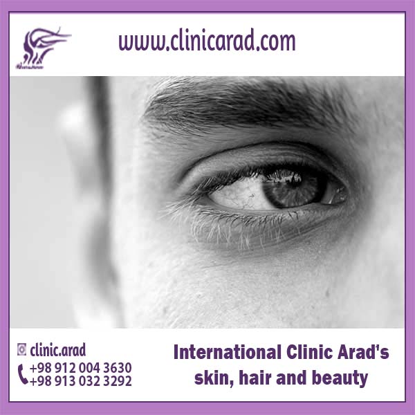 behind eyelid Surgery گردشگری سلامت آنلاین