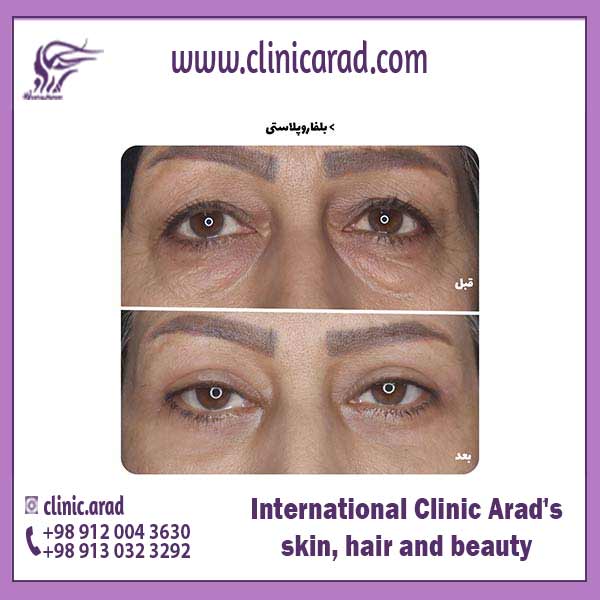 Cost of Puffy Eye Surgery گردشگری سلامت آنلاین